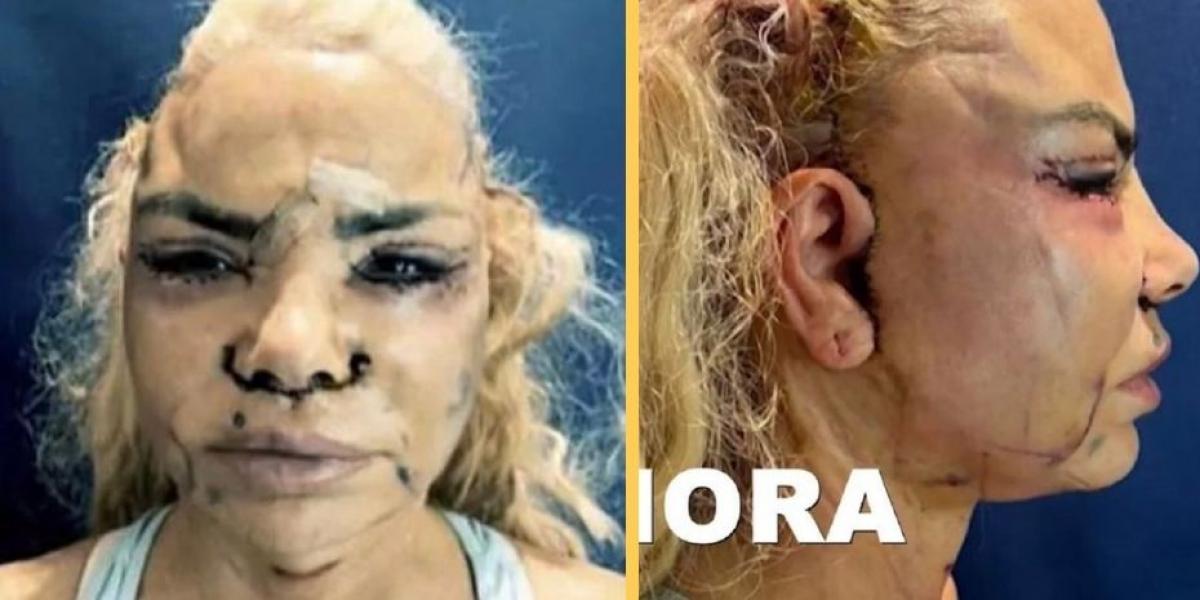 Así quedó el rostro de Leticia Sabater tras sus últimas operaciones