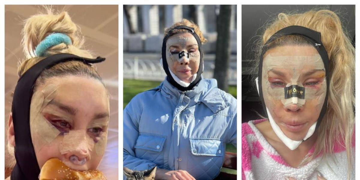 La Pelopony revela el dineral que se ha dejado en su operación facial en Turquía